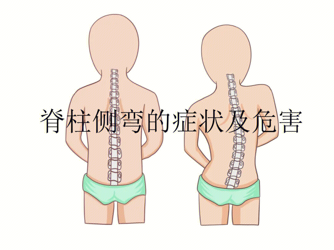 脊柱侧弯的症状和危害有哪些