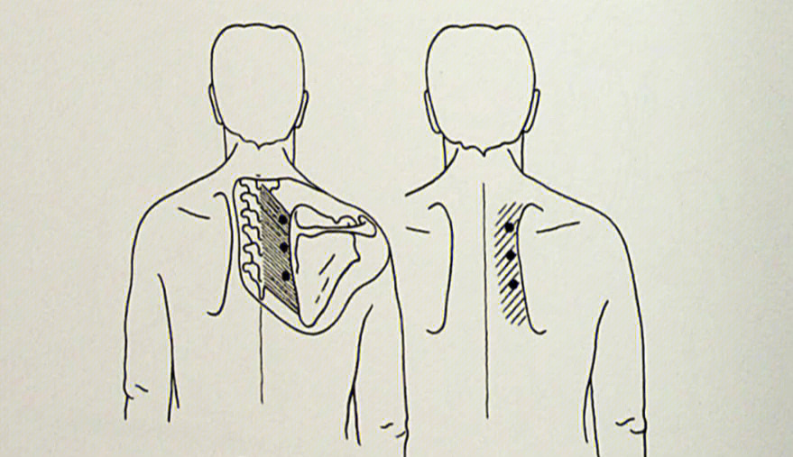 肩胛骨内侧疼痛的主要肌肉—菱形肌