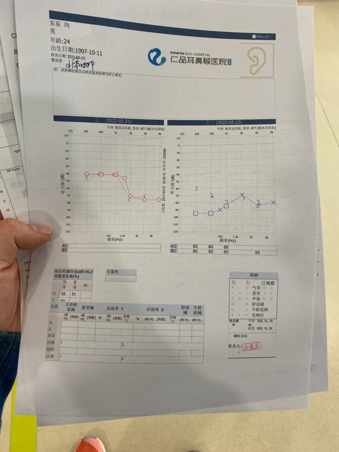 突发性耳聋耳鸣