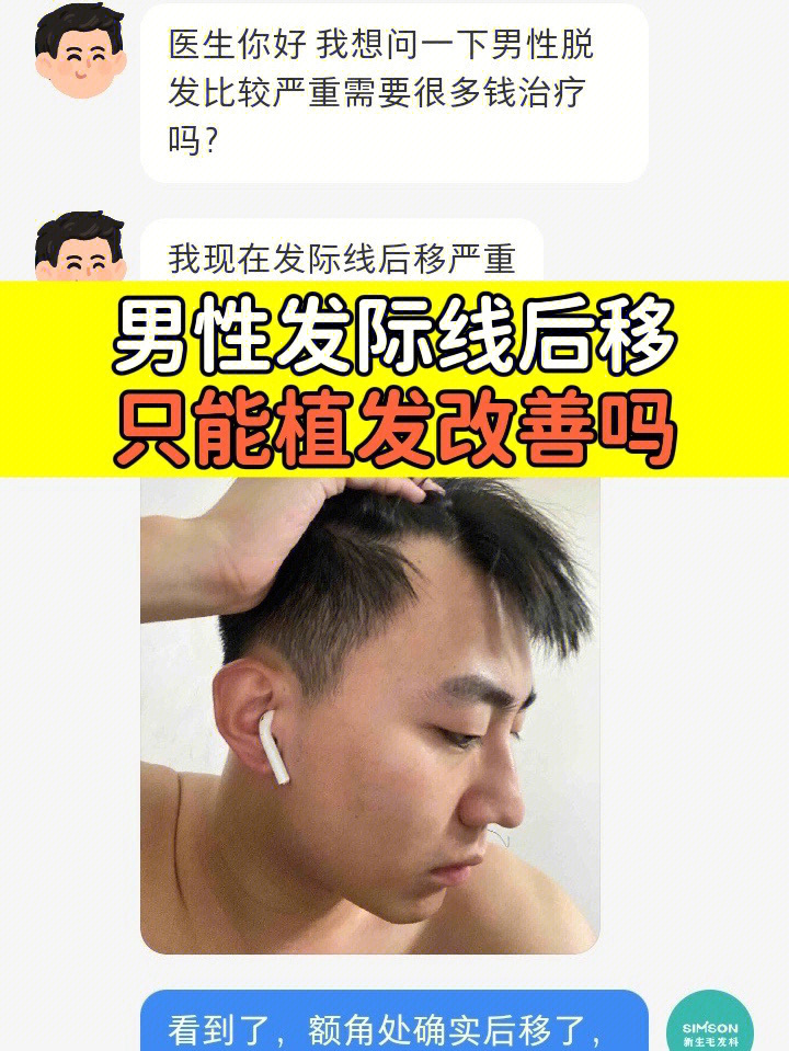 男性发际线后移严重只能植发改善吗