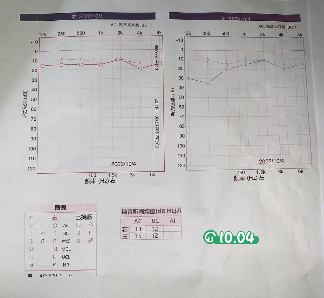 谁看得懂听力检查报告01年纪轻轻竟然突聋