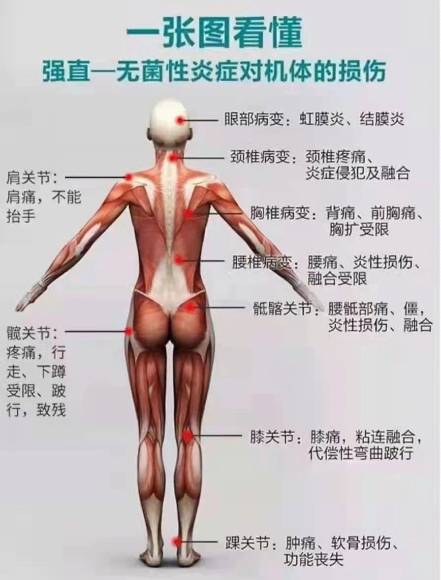 强直性脊柱炎治疗#生物制剂#风湿免疫 疼痛并发部位分类,娠物