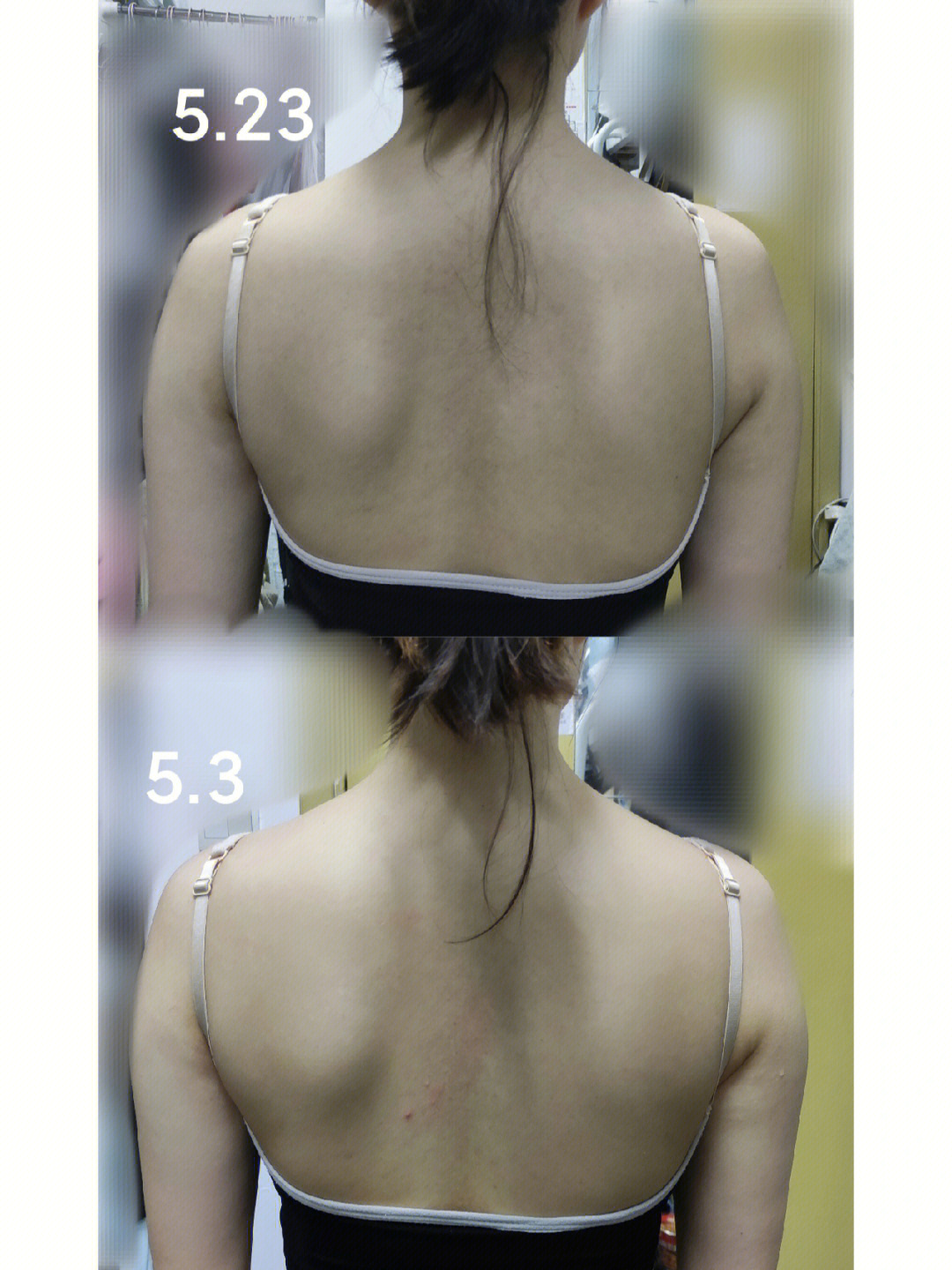 翼状肩胛手术图片