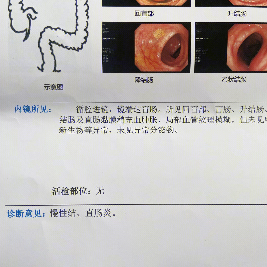 6种症状需做肠镜检查图片