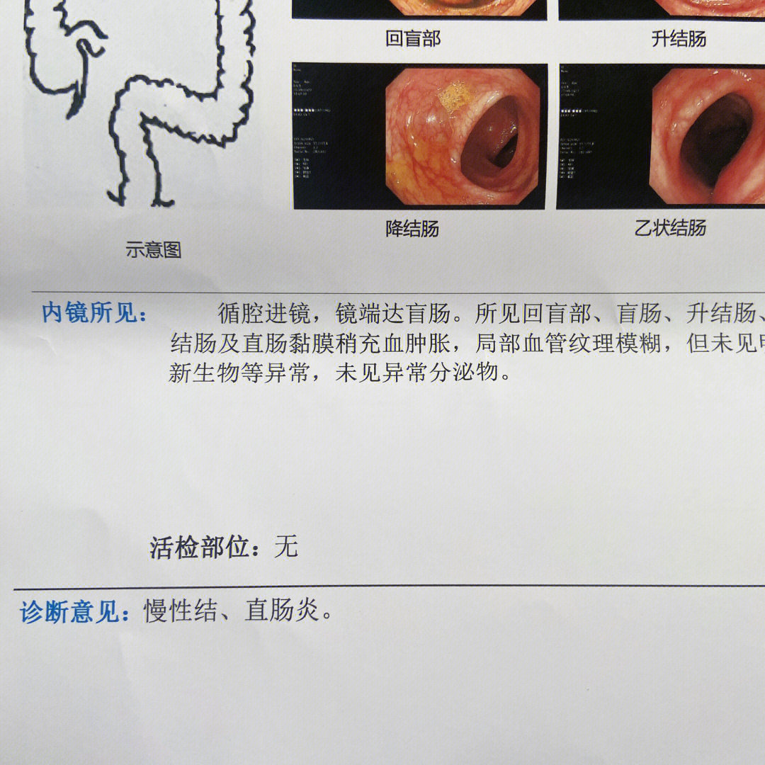 我的肠镜检查终于完成