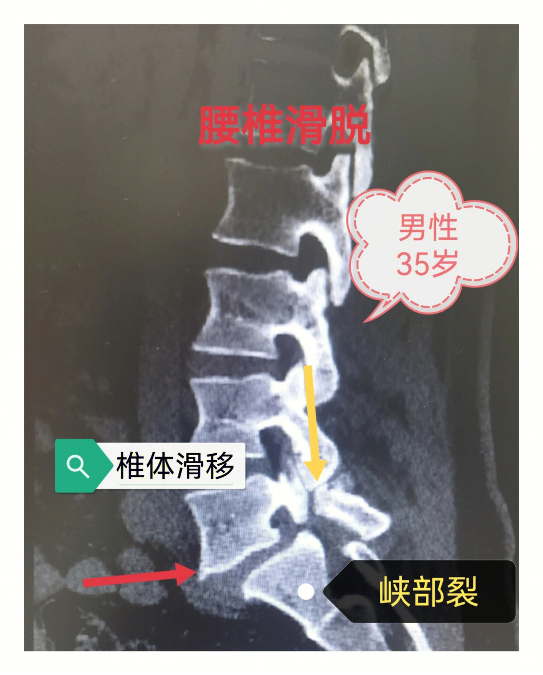 腰椎峡部裂腰椎滑脱