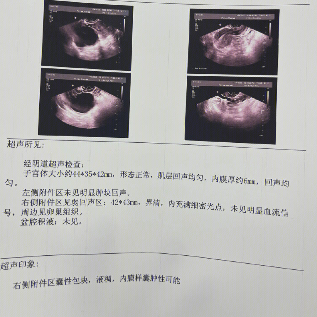 巧克力囊肿手术经历记录一