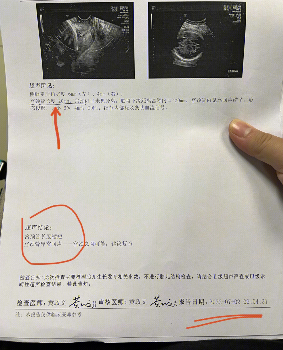宫颈管短图片
