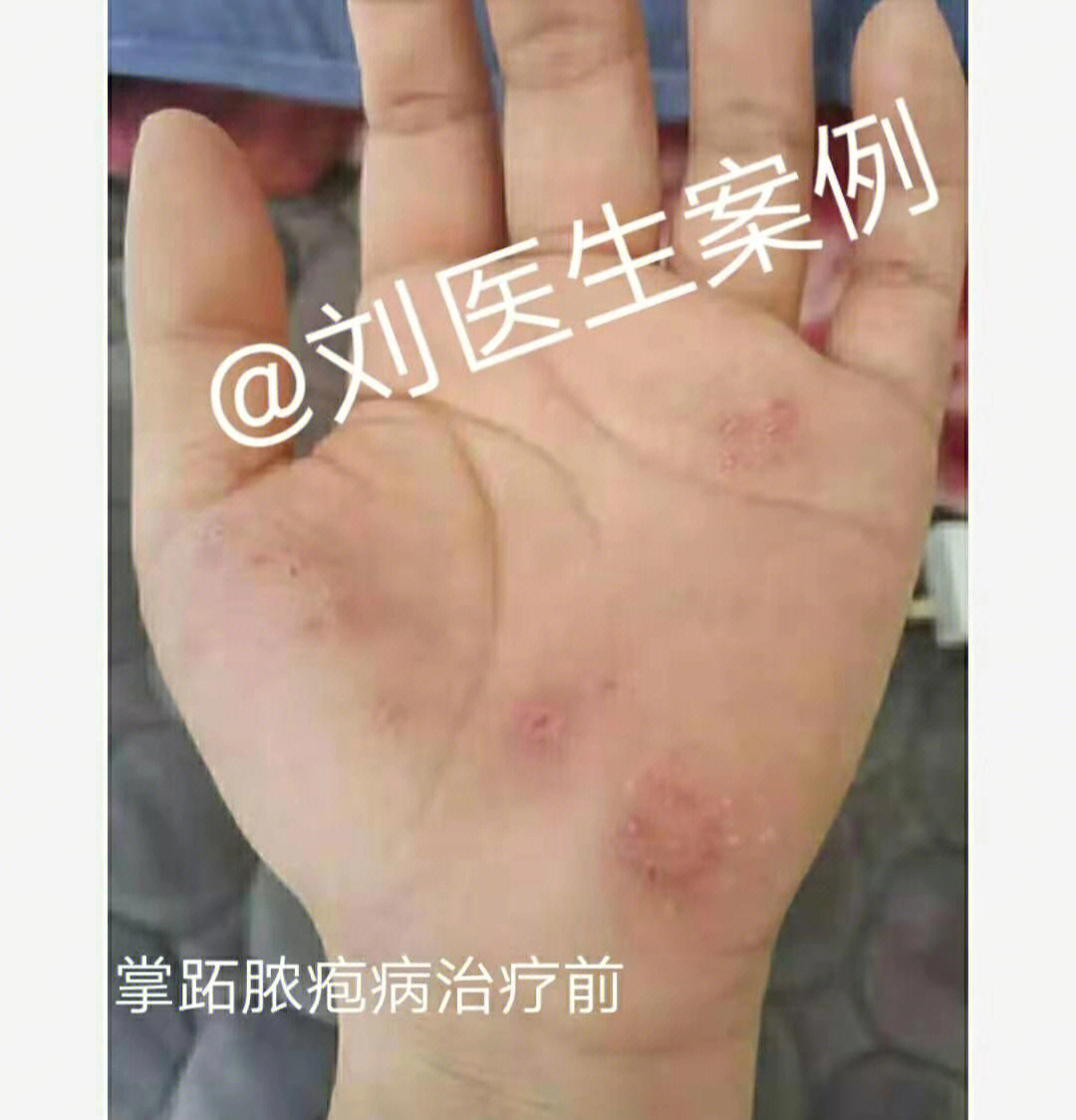 先天性皮毛窦图片