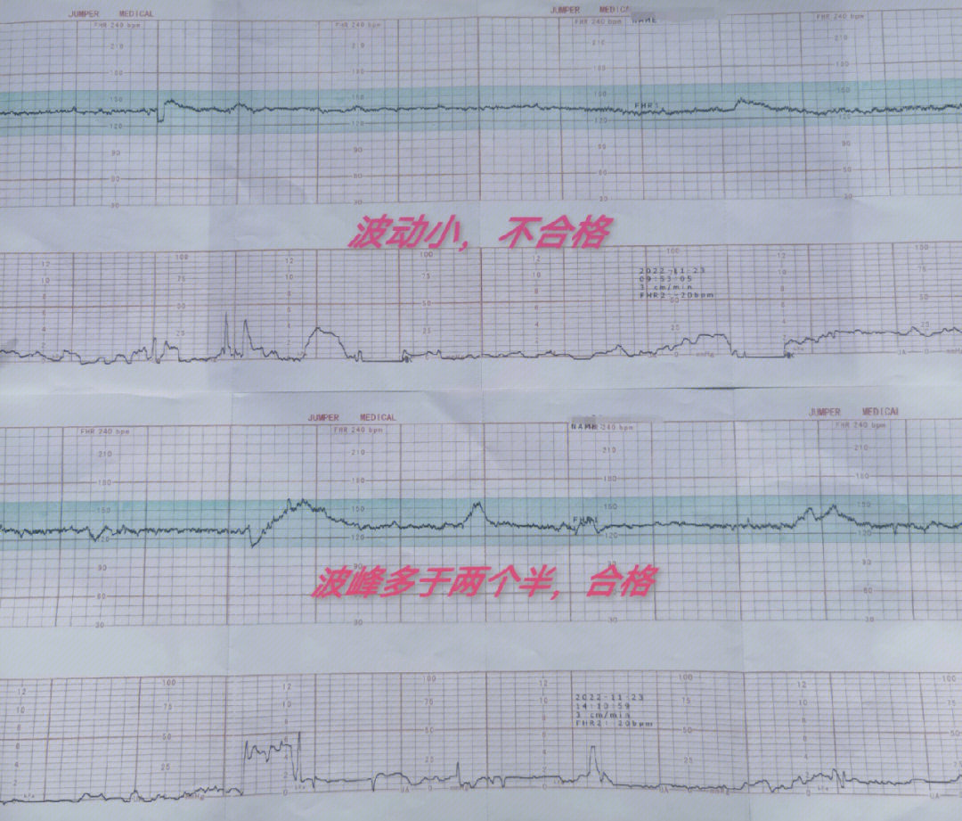 胎心监护合格图片图片