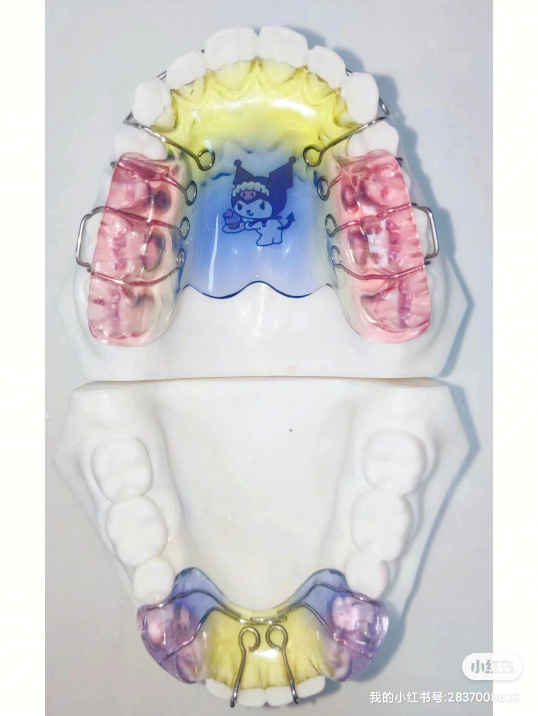 颌垫舌簧矫治器适应症图片