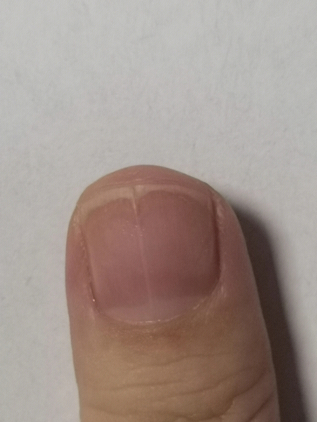 大拇指指甲裂纹图片图片