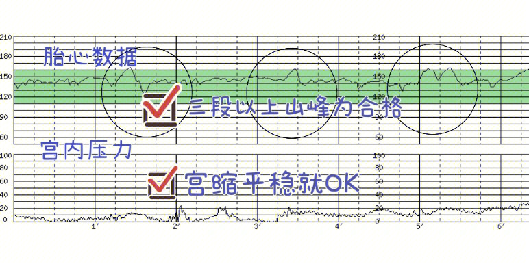 胎心监护一次过的总结