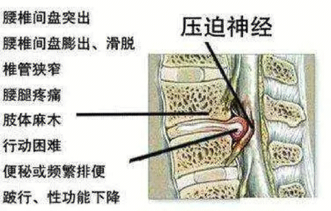 腰45椎间盘突出症状图片