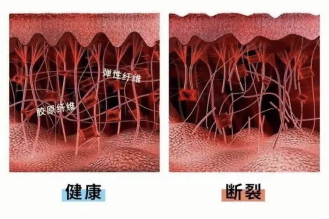 肌肉纤维撕裂图片图片