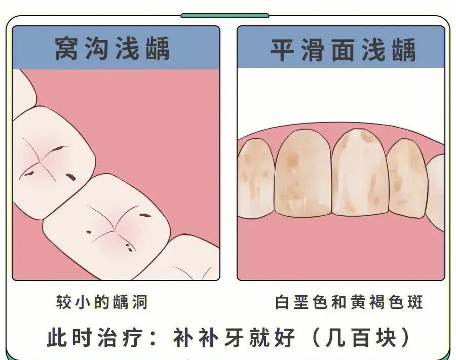71 浅龋:黑化30%浅龋是指在窝沟处或者牙齿平滑面出现的小黑点