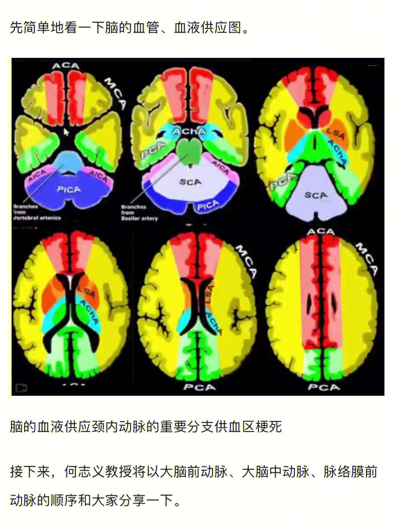 脑梗核磁图片解说图图片