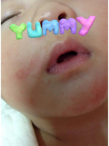 婴儿湿疹消退过程图片图片