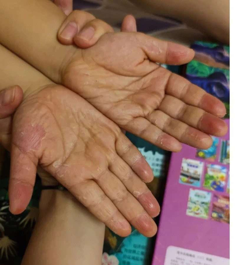 小孩的手脱皮一定是病吗?【第798篇】