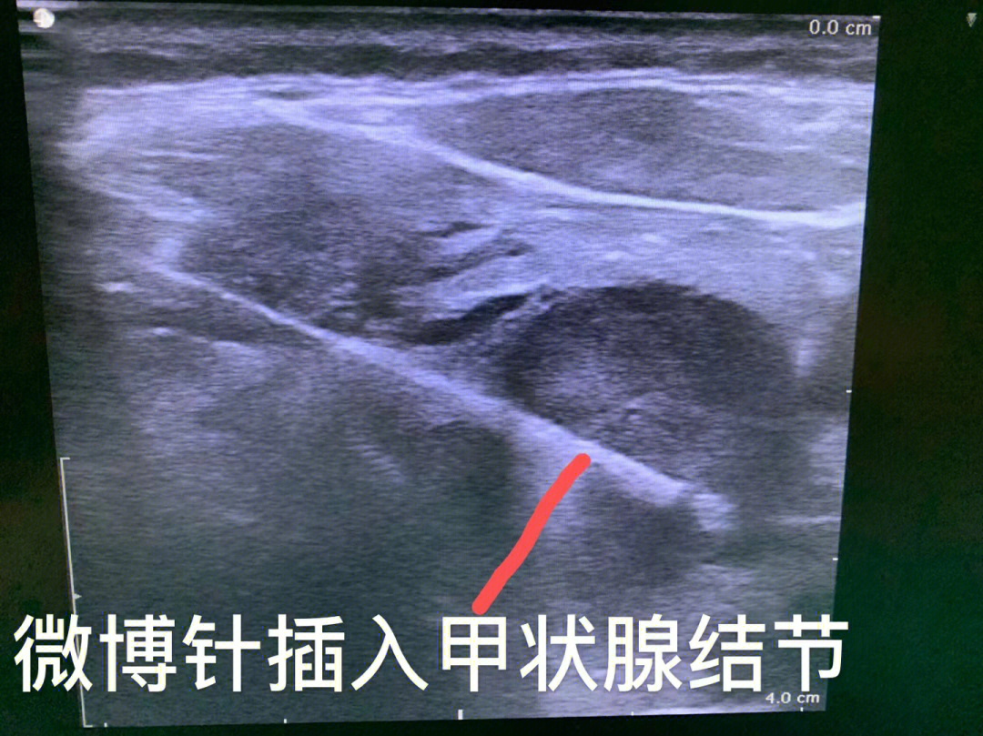 甲状腺结节的微波消融安全高效