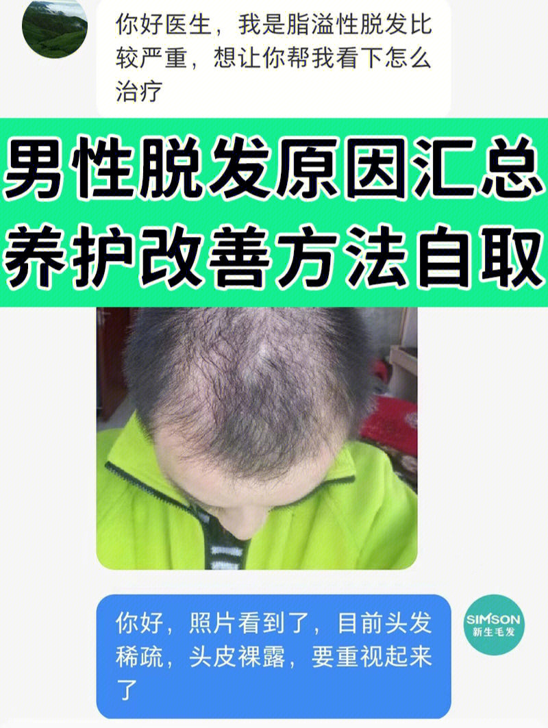 快看男性脂溢性脱发原因汇总