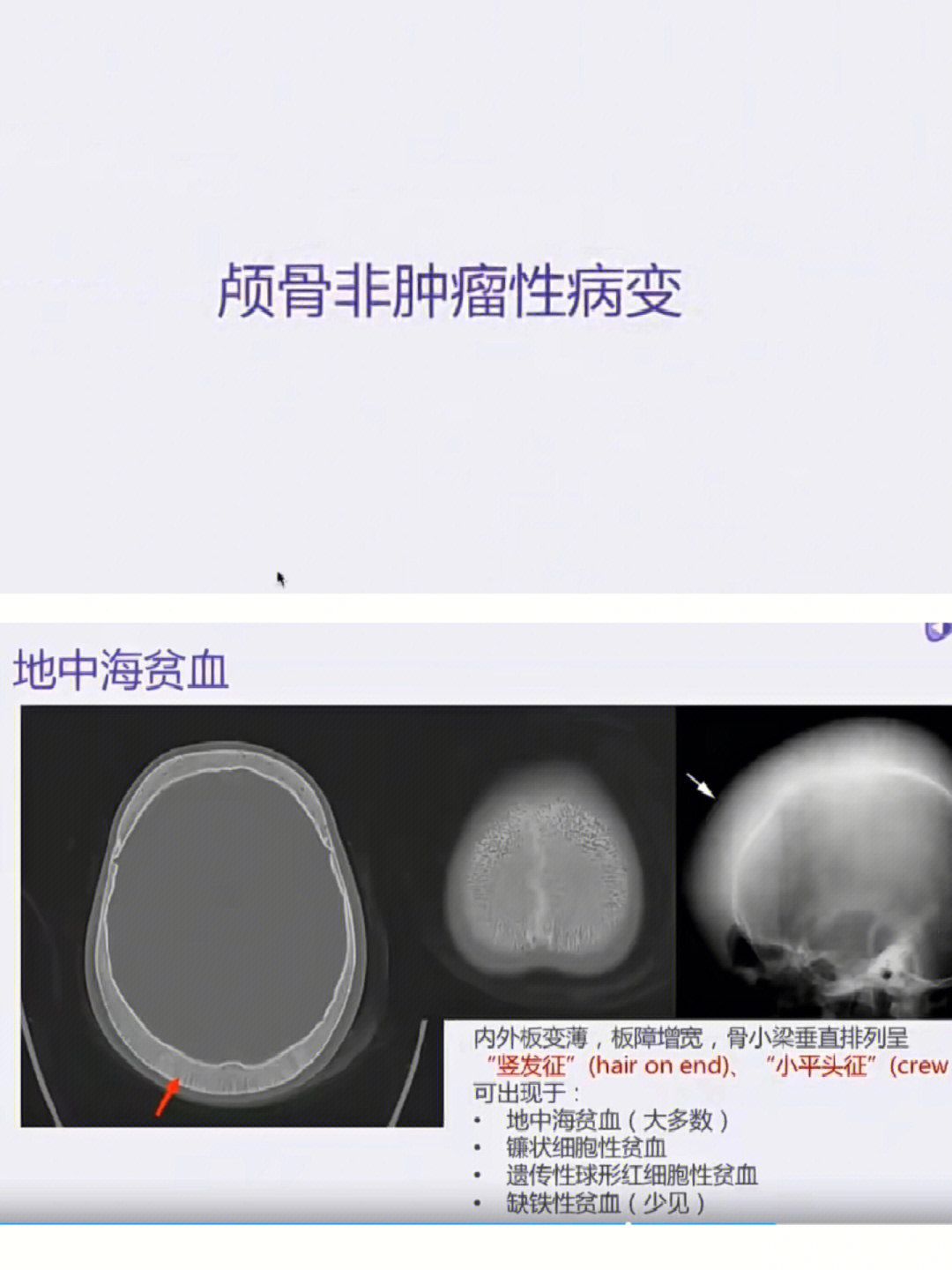 颅骨多发性骨髓瘤图片