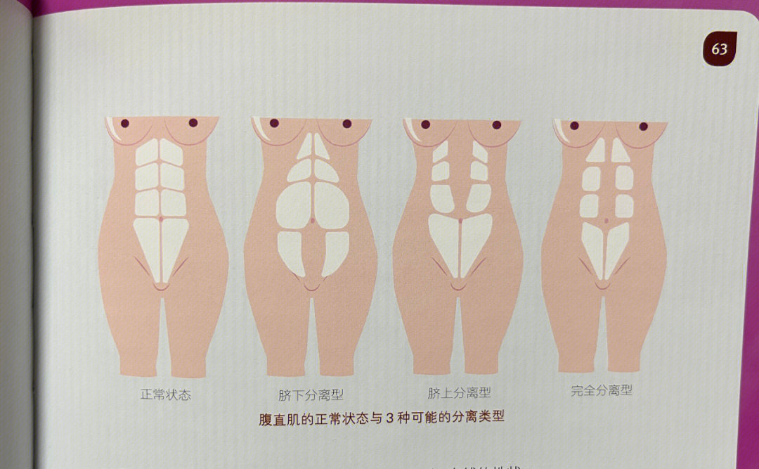 腹直肌正常与分离图片图片