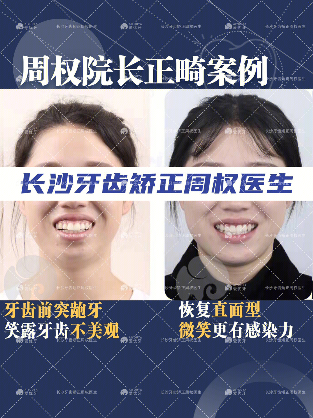 儿童露龈笑几岁矫正图片