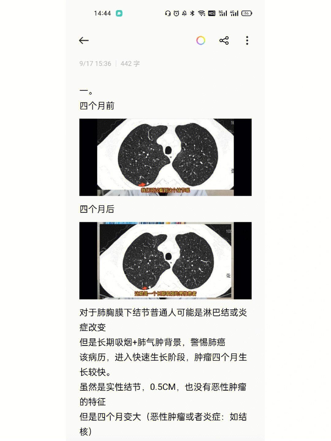 肺气肿能活多久寿命图片