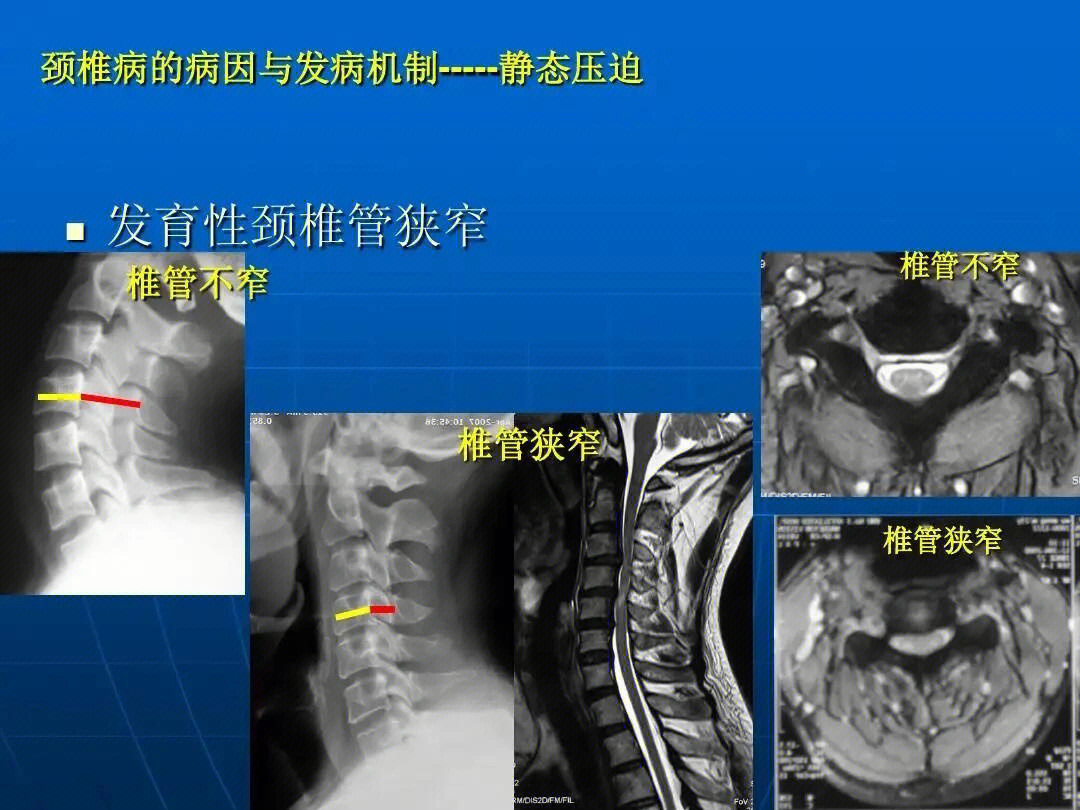 颈椎病的症状图片大全图片