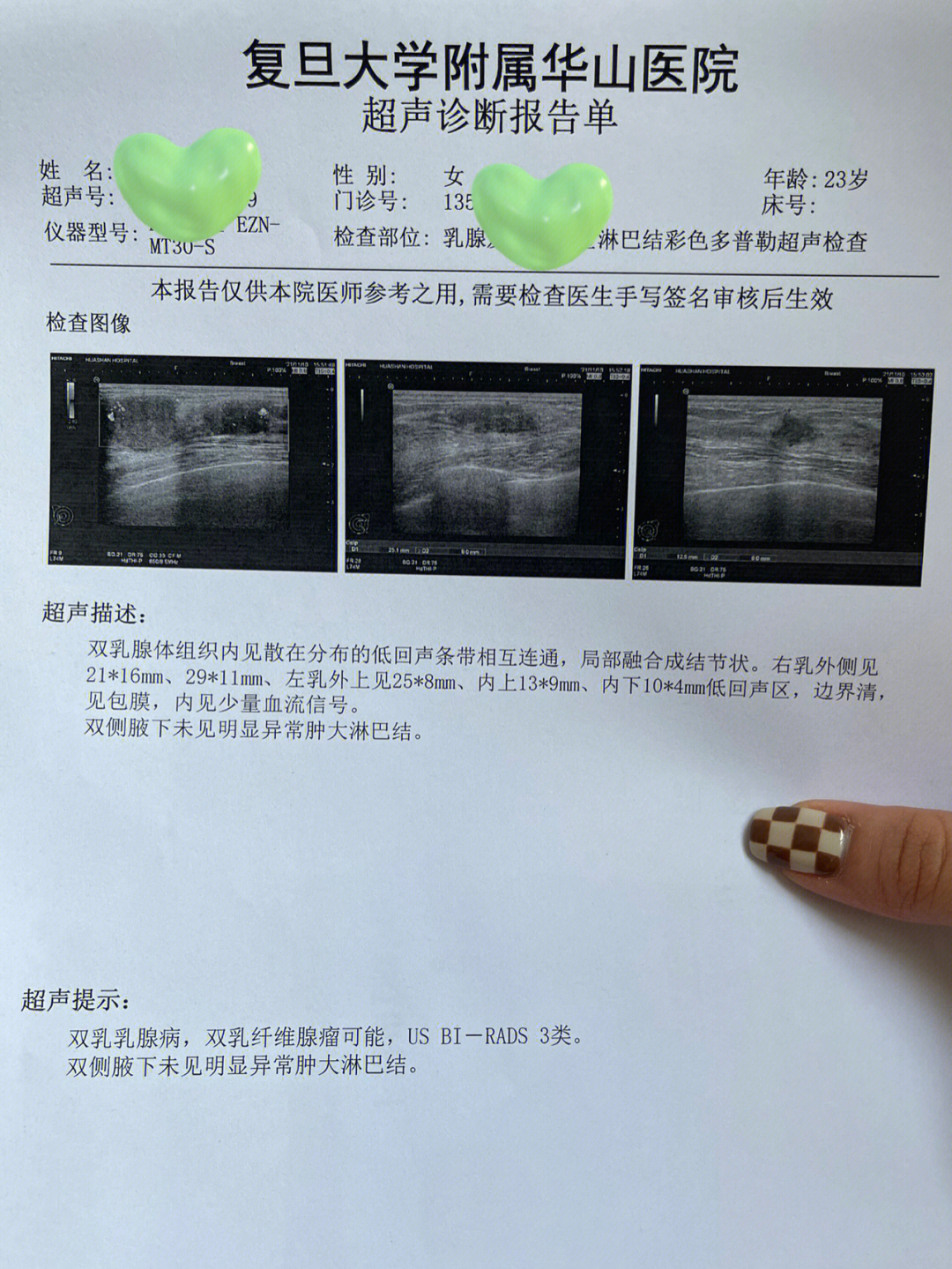 23岁双乳纤维瘤3类——华山医院蔡振鑫教授(上