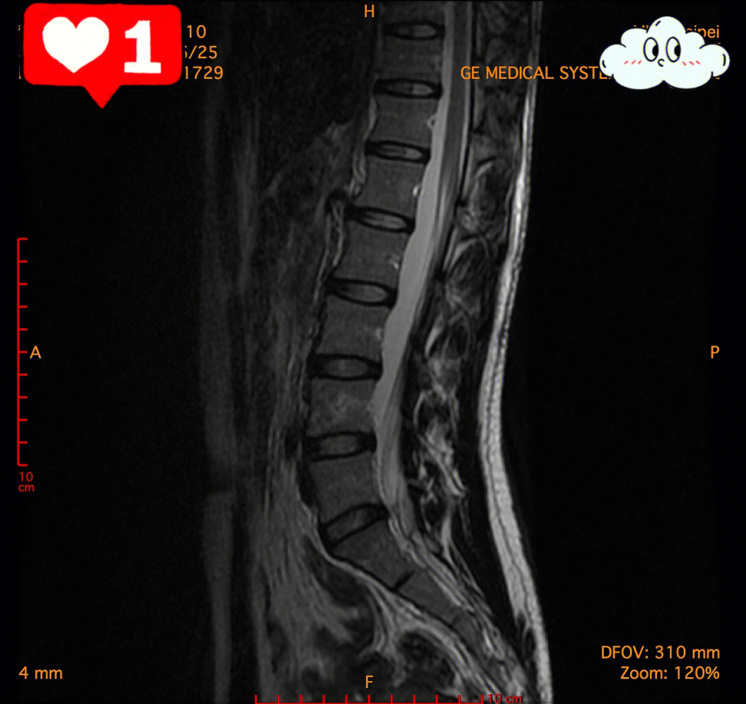 左手不知為何也跟著麻mri報告l4l5輕微腰椎間盤突出物理治療都沒什麼