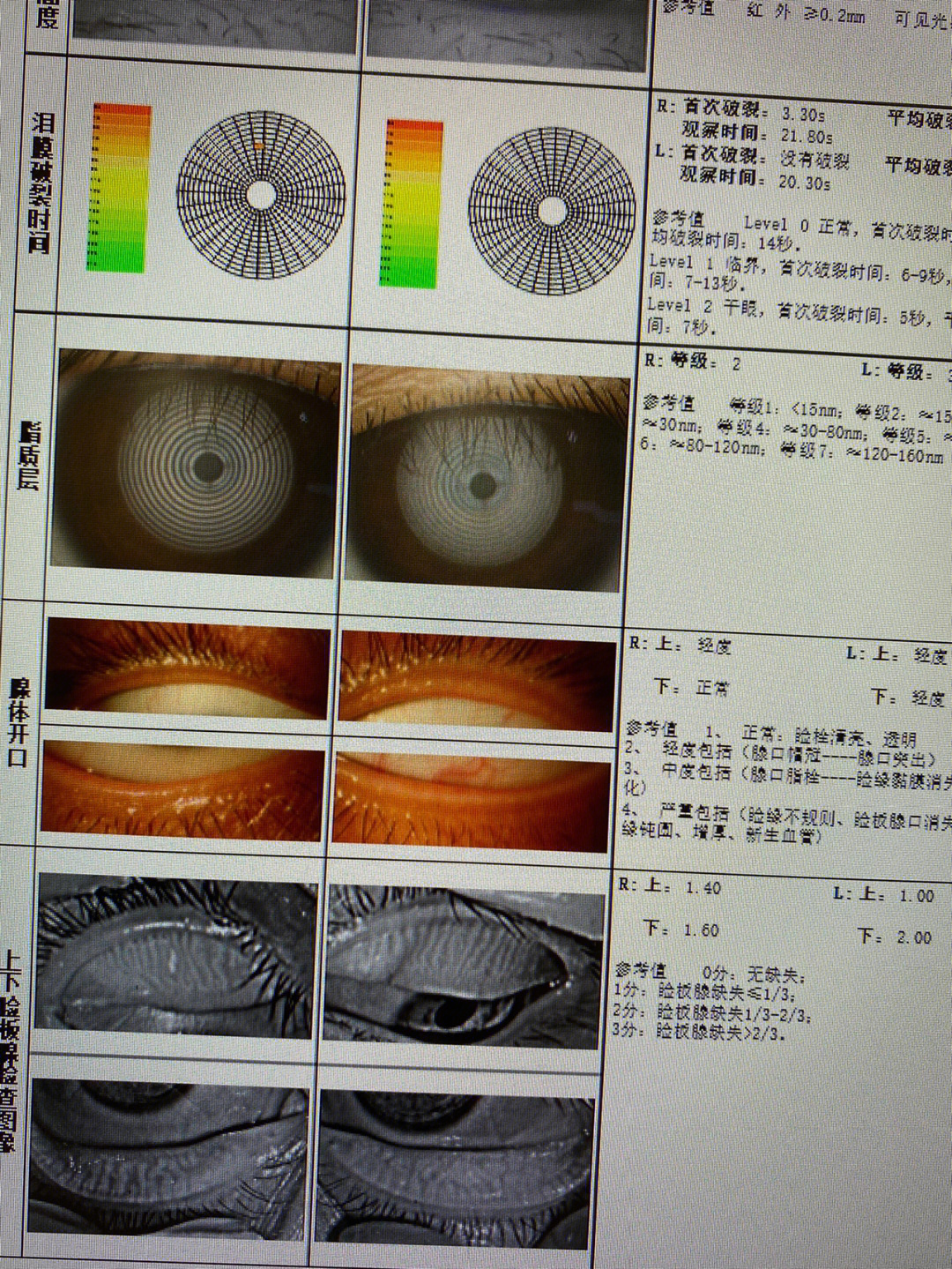 眼睛干涩  赶快给眼睛做个检查吧很早之前做过一次眼睛检查眼睛不大