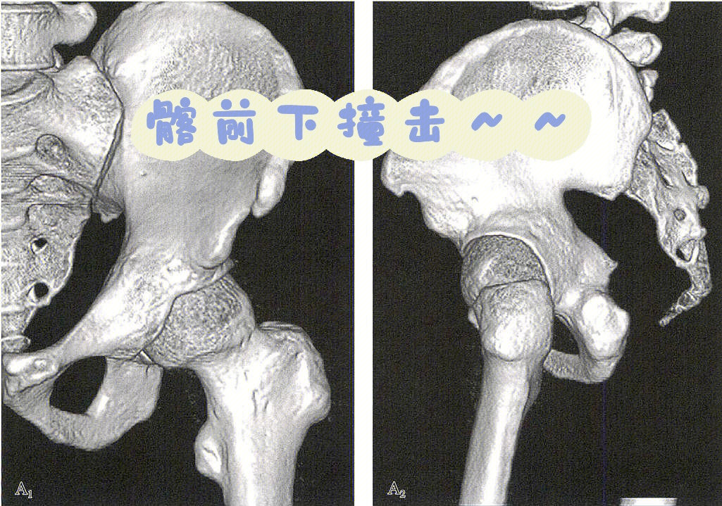 hi髂前下撞击