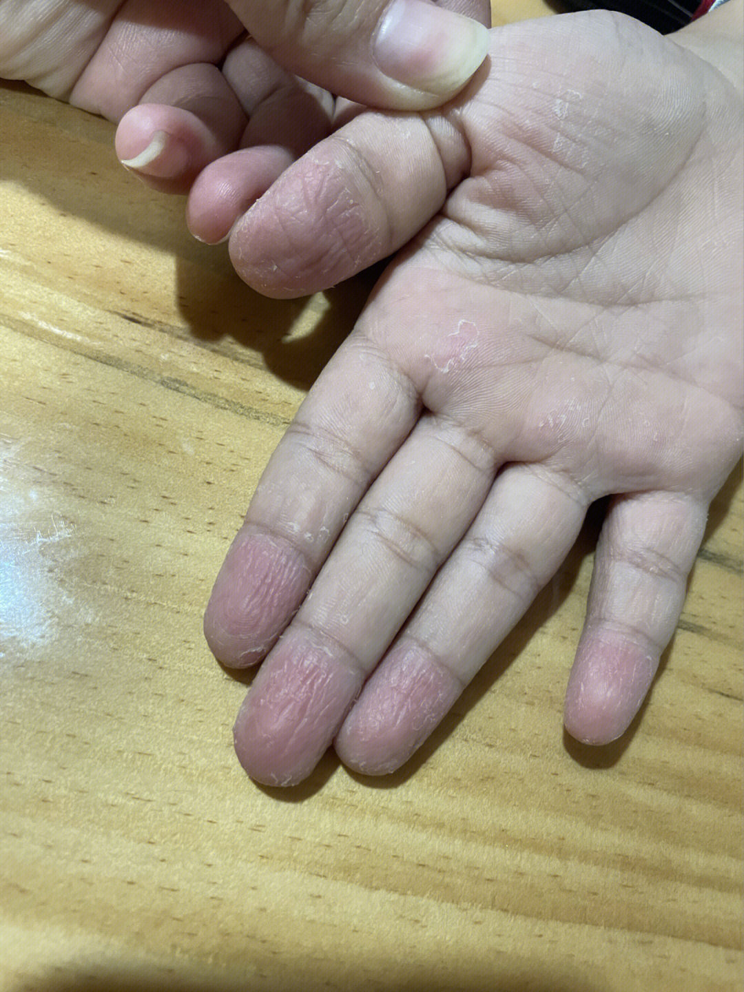 儿童手指剥脱性皮炎图片