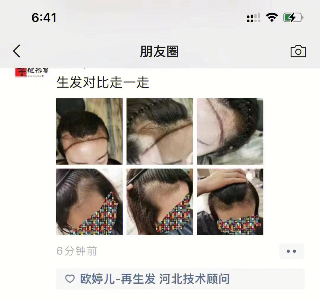 头发两边鬓角秃怎么办图片