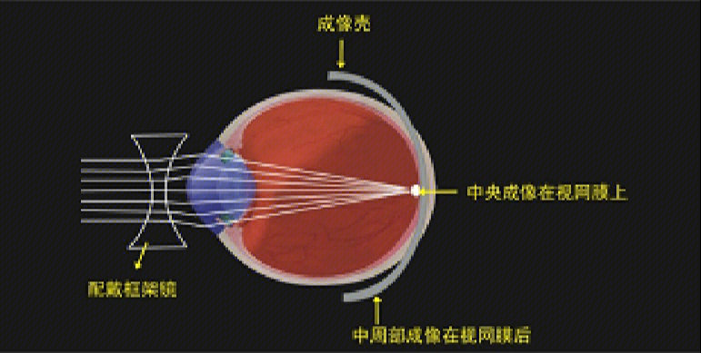一图读懂角膜塑形镜控制近视原理