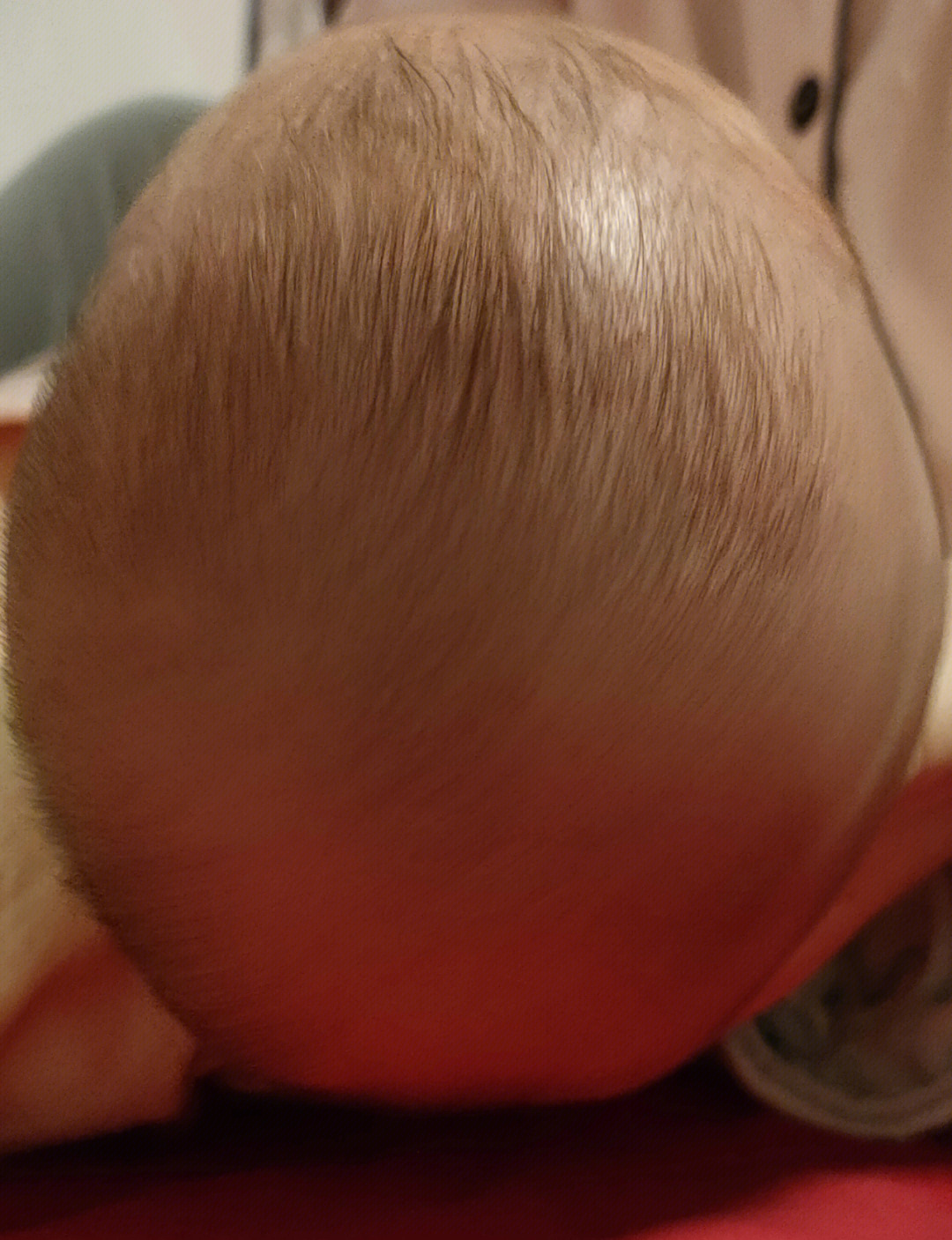 宝宝二个月6天,现在头型舟状头,两侧犄角明显,耳朵两边凹陷厉害