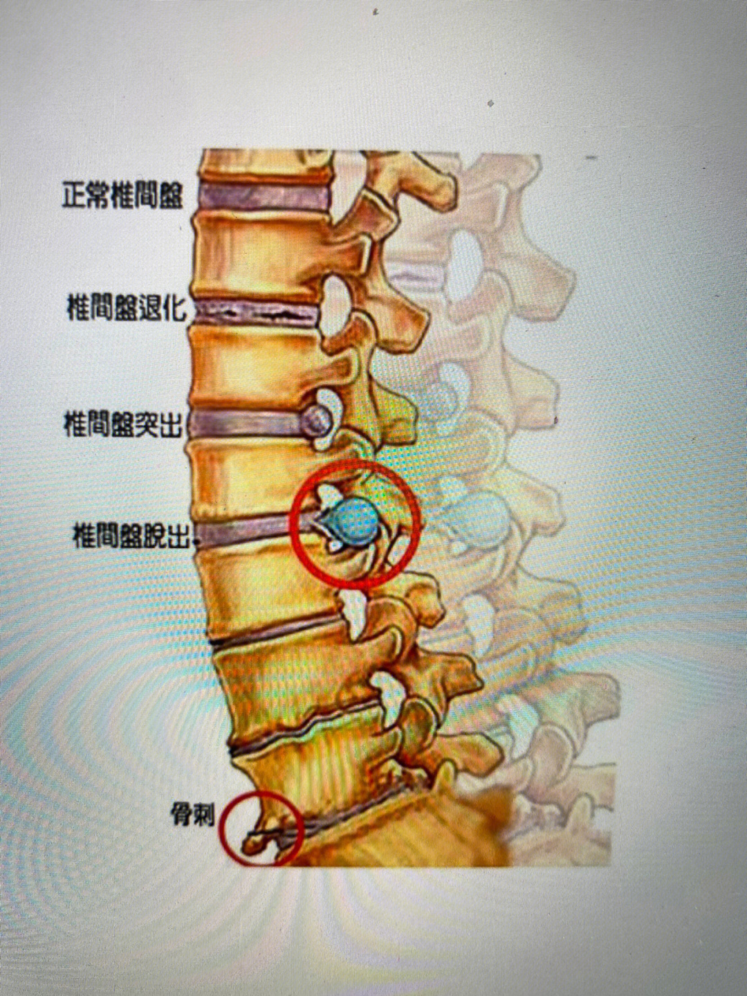 骨盆骨刺图片图片