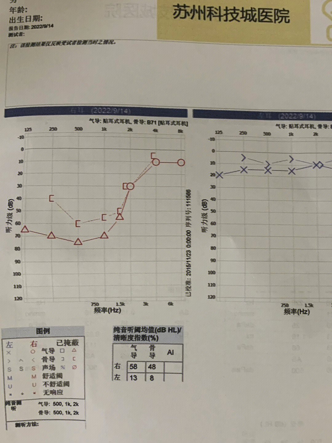 突发性耳聋