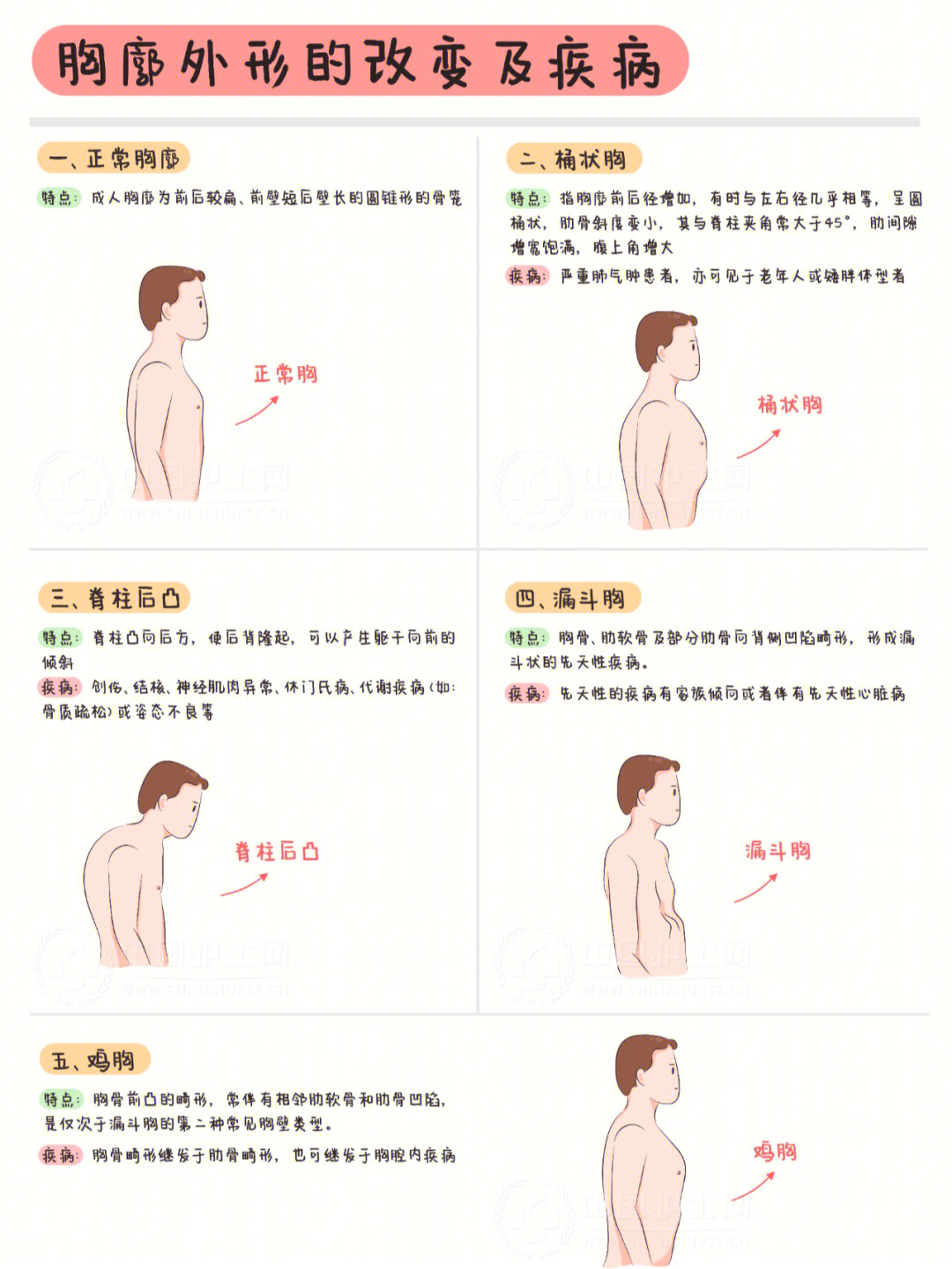 儿童桶状胸图片