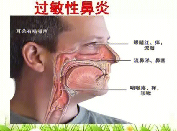 鼻窦炎的治疗的方法图片