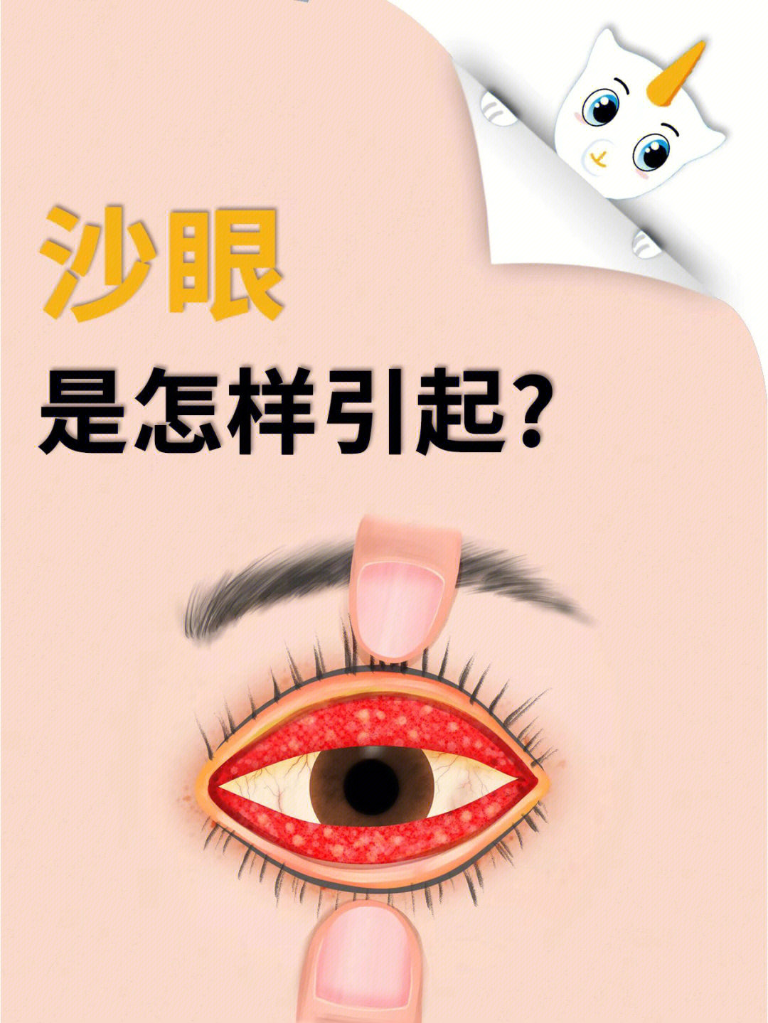 沙眼是沙子进入眼睛引起的吗63