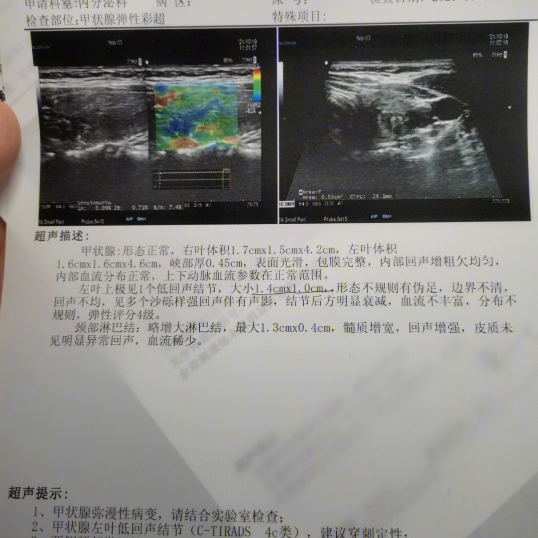 甲状腺穿刺报告解读图片