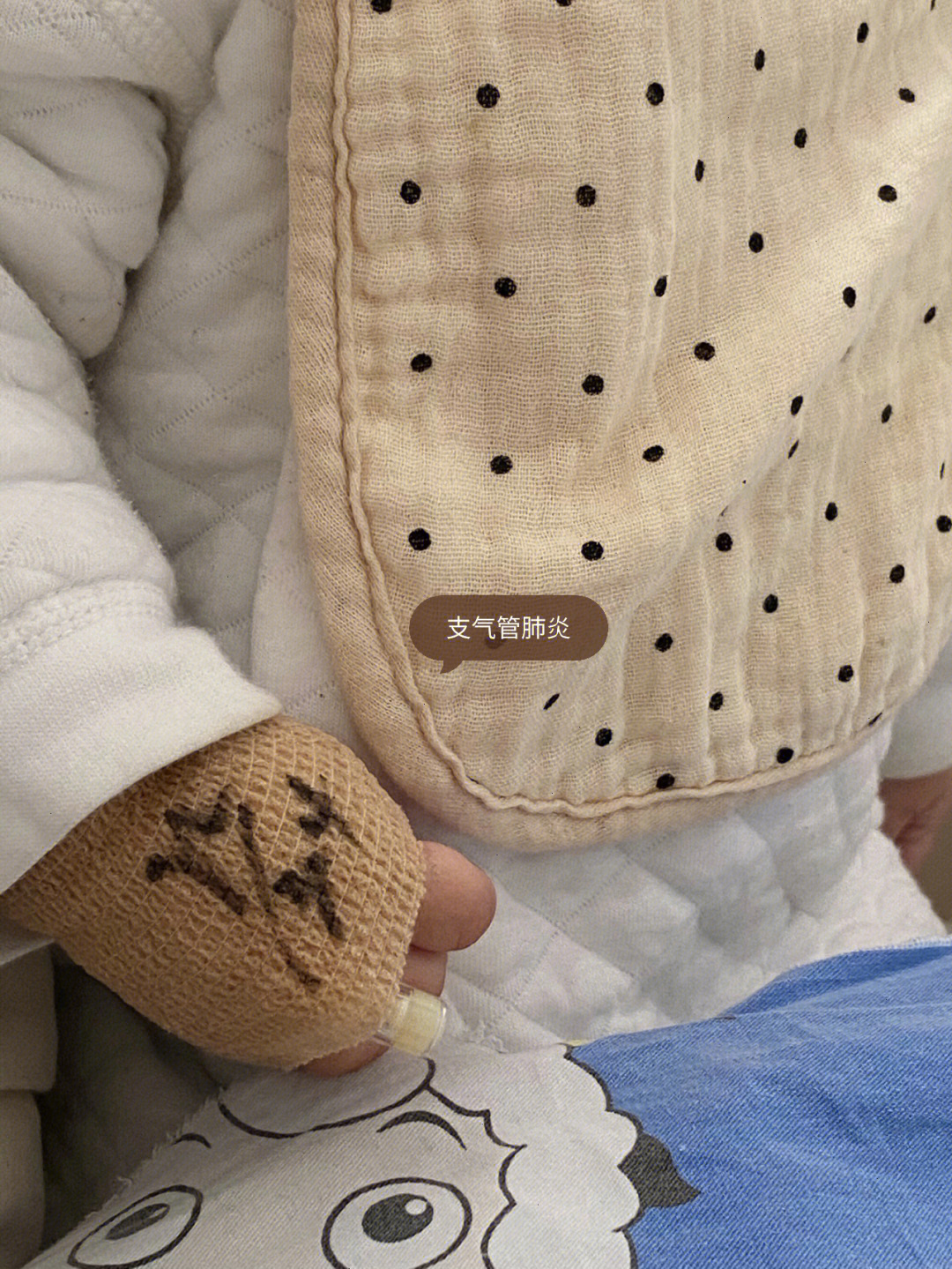 婴儿肺炎口周发青图片图片
