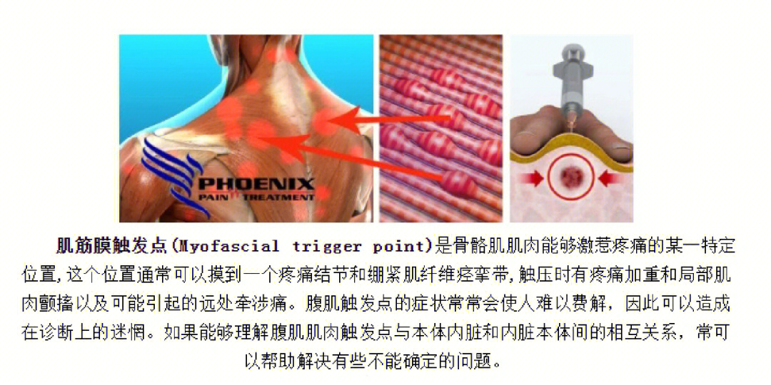 了解腹肌肌筋膜触发点的重要性