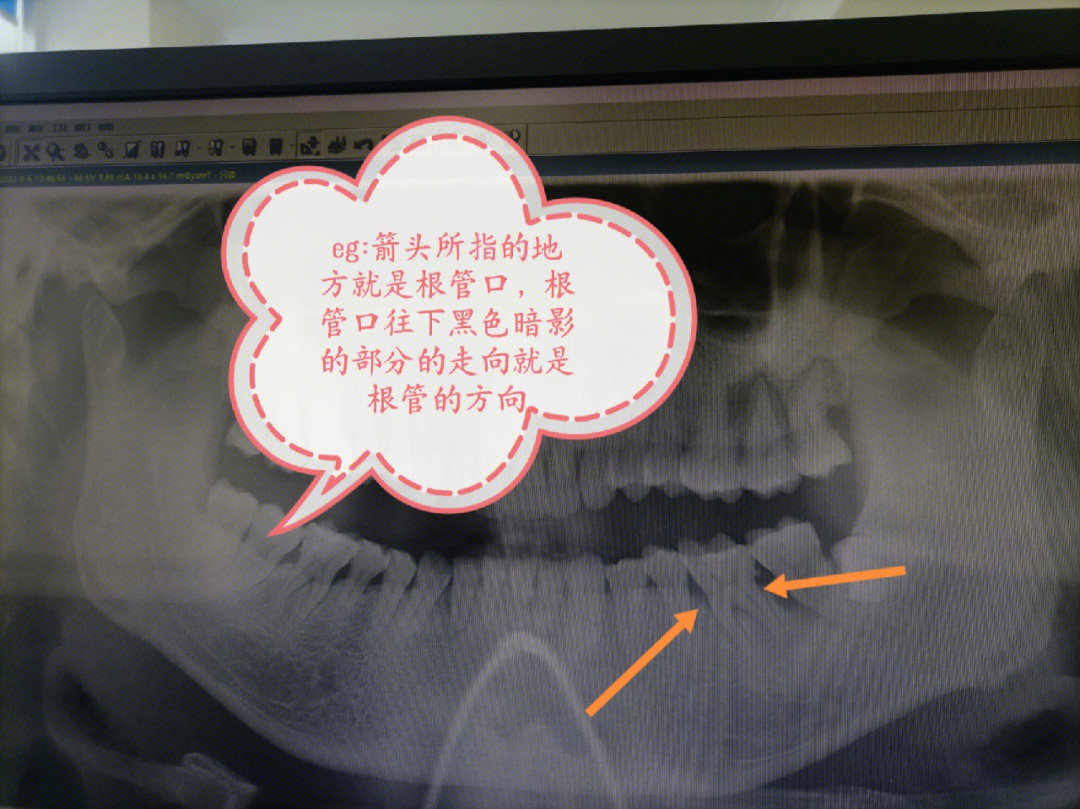 牙根远中近中示意图图片