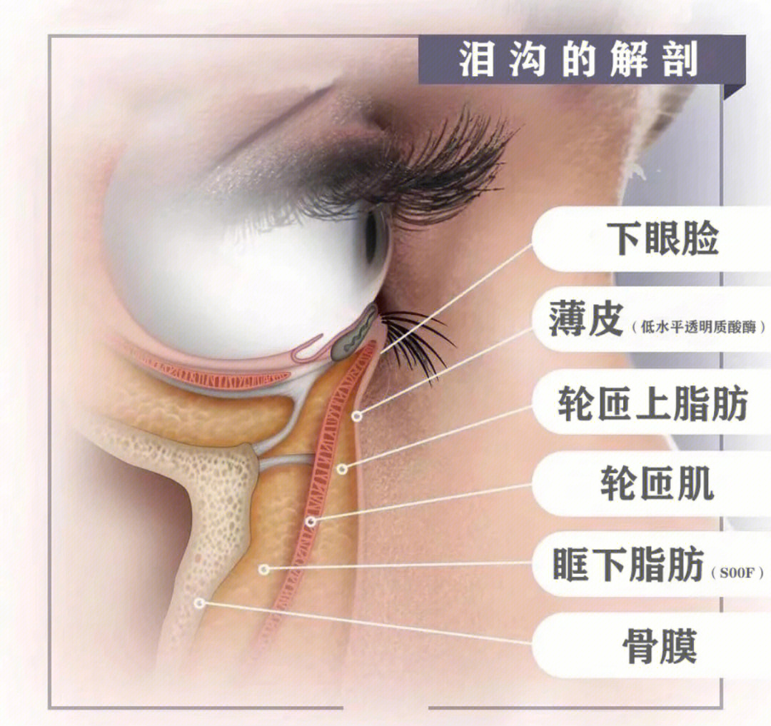 泪沟型眼袋形成的原因图片