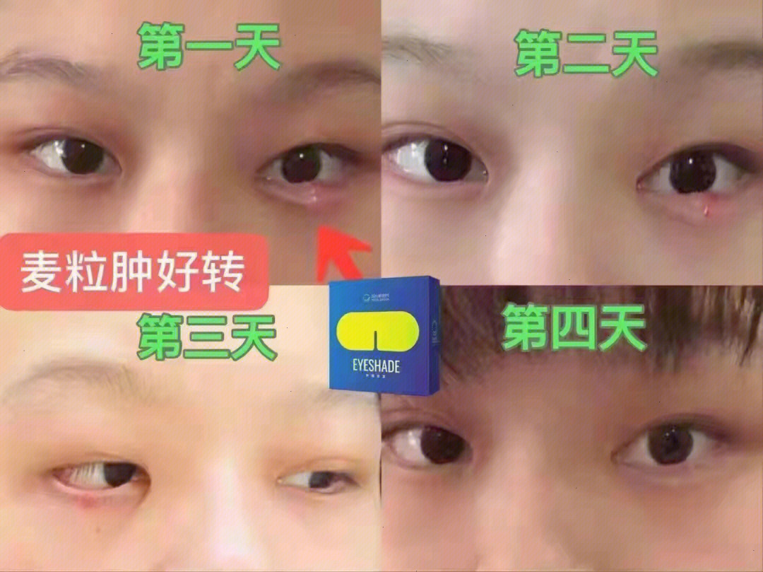 针眼几天能好图片