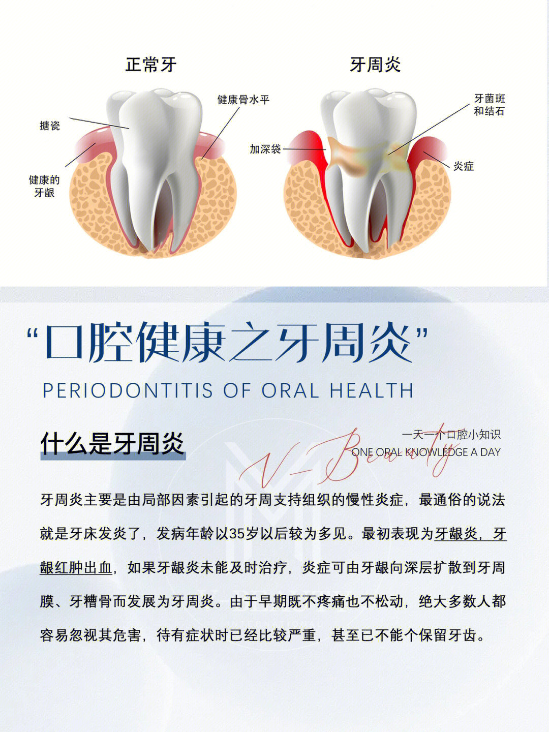 牙周炎原因图片